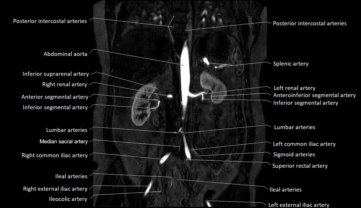 MRA Abdomen coronal anatomy image 25.webp